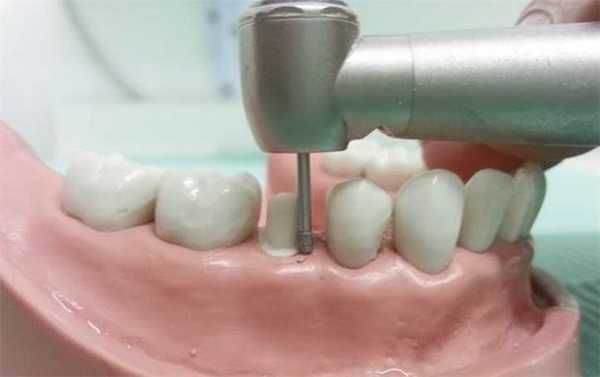 Зуб подготавливают к протезированию, обтачивают, формируют культю