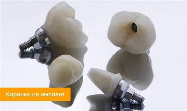 Фото коронок для имплантов