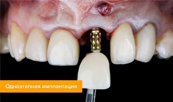 Фото одноэтапной имплантации