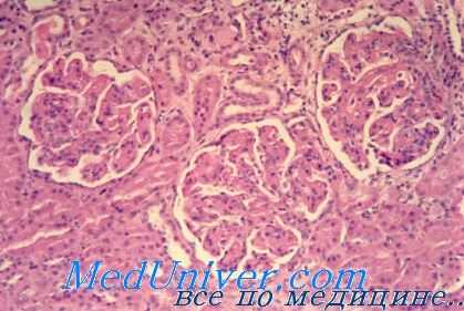 тубулоинтерстициальный нефрит у детей