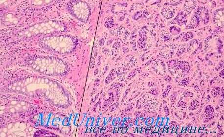 рак-карцинома жкт