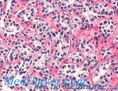 рак пищеварительного тракта