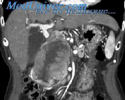 множественные опухоли жкт