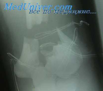 травма грудной клетки