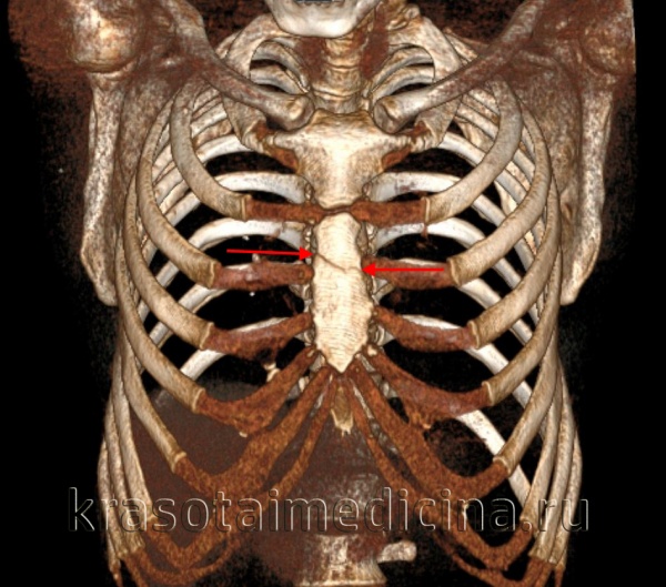 Повреждения грудной клетки