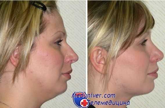 липосакция лица