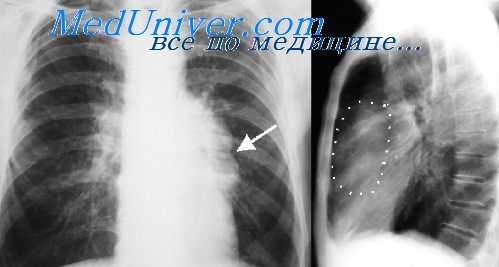 дермоидные кисты