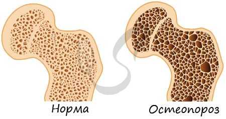 Остеопороз