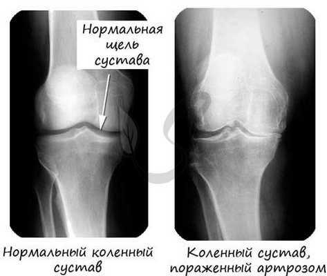 Артроз коленного сустава