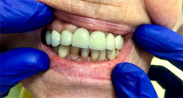 Металлопластмассовые зубные мосты