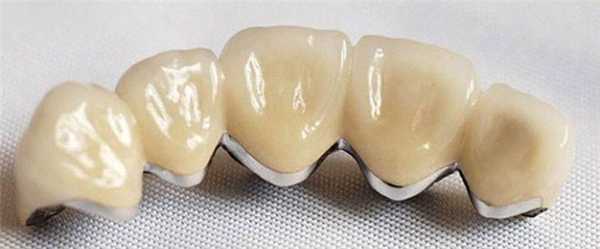 Металлокерамический мостовой протез