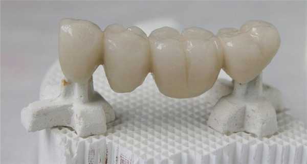 Мостовидный протез