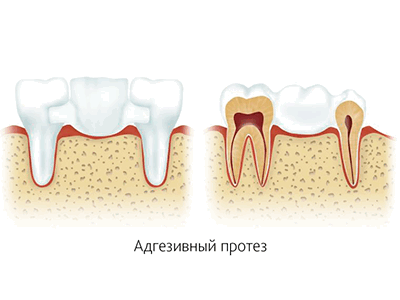 фиксация мостовидных протезов фото