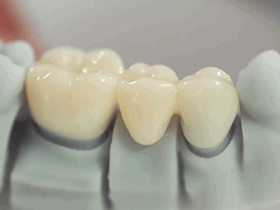 части мостовидного протеза фото