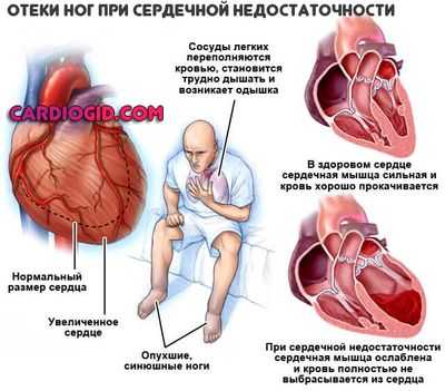 отеки-ног-при-сердечной-недостаточности