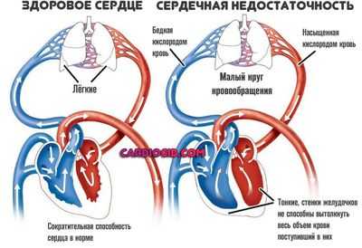 сердечная-недостаочность