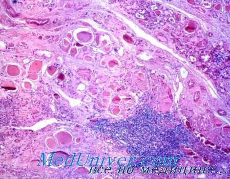 рак щитовидной железы