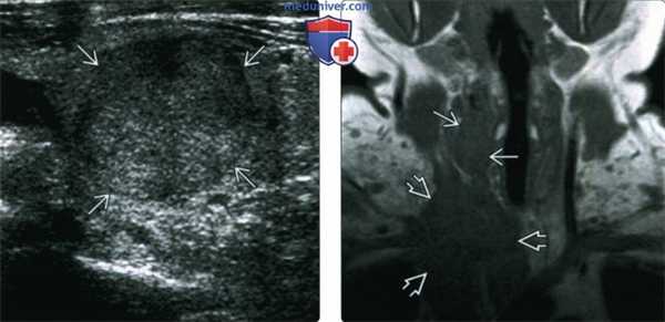 КТ, МРТ, УЗИ при медуллярном раке щитовидной железы