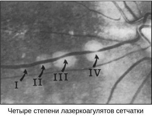 Результат успешного лечения периферической дистрофии сетчатки