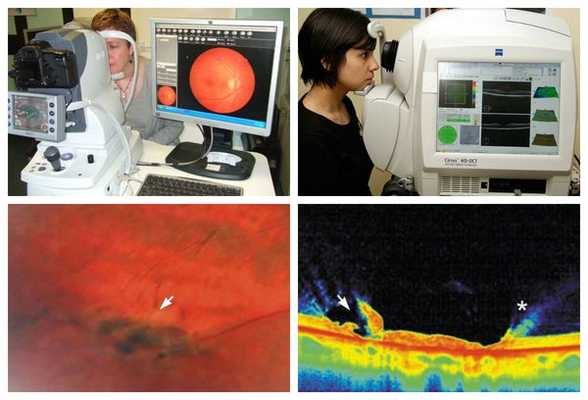 Исследование сетчатки с использованием фундус-камеры и проведение оптической когерентной томографии