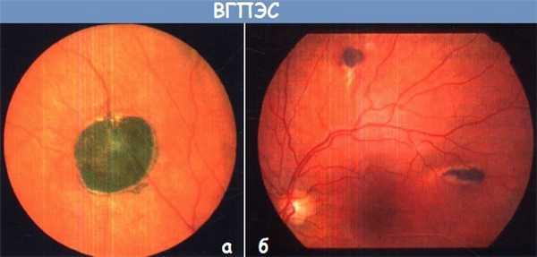 Врожденная гипертрофия пигментного эпителия сетчатки (ВГПЭС)