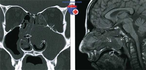 КТ, МРТ при солитарном полипе носа, пазухи