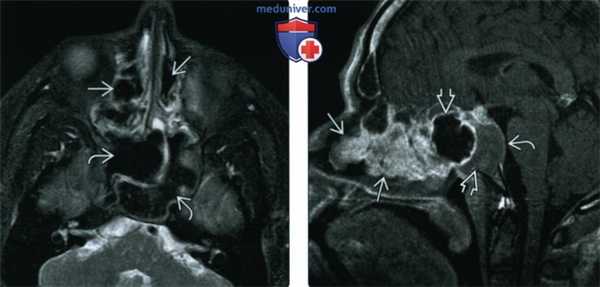 КТ, МРТ при полипозе носа и пазух