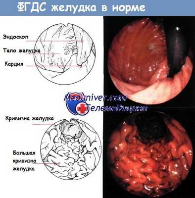 ФГДС желудка в норме