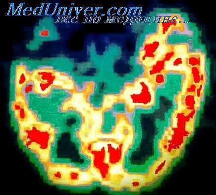 эпилептическая система