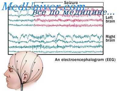 эпилепсия