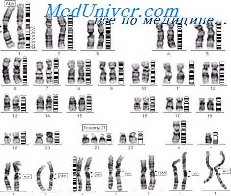 Кариотип синдрома Дауна
