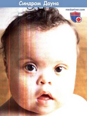Синдром Дауна