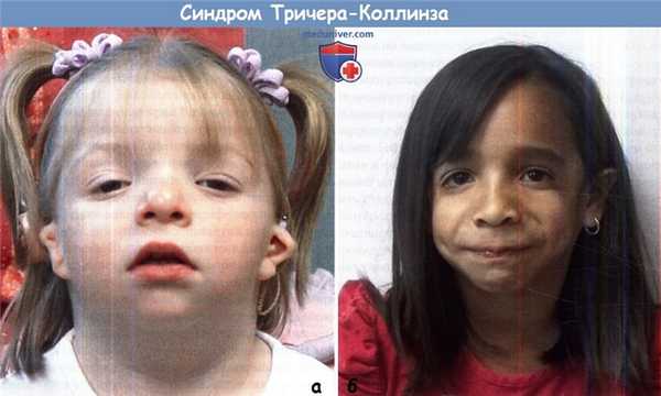 Синдром Тричера-Коллинза