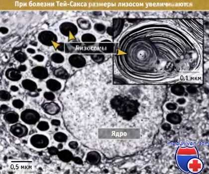 Лизосомы при болезни Тея-Сакса