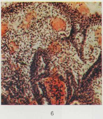 Рис. 6. Микропрепарат папиллярной сирпнгоаденомы: сосочковые разрастания с лимфоплазмоцптарной инфильтрацией и полнокровием сосудов (желтого цвета) стромы; стрелками указаны железистоподобные тубулярные структуры; окраска гематоксилин-эозином; х 100.