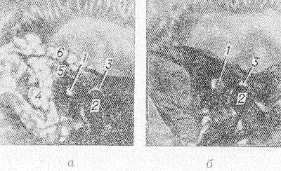 Рис. 3. Рентгенограммы сосцевидного отростка в норме при пневматическом (а) и склеротическом (б) типах строения (правая боковая проекция по Шюллеру): 1 — наружный и внутренний слуховые проходы; 2 — головка нижней челюсти; 3 — суставная впадина височно-нижнечелюстного сустава; 4 — верхушечные ячейки; 5 — периантральные ячейки; 6 — ячейки чешуи височной кости.