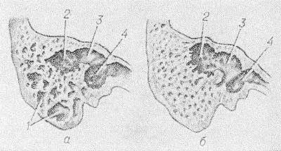 Рис. 2. Схематическое изображение сосцевидного отростка на разрезе при пневматическом (а) и склеротическом (б) типах строения: 1 — ячейки сосцевидного отростка; 2 — сосцевидная пещера; 3 — вход в сосцевидную пещеру; 4 — барабанная полость.