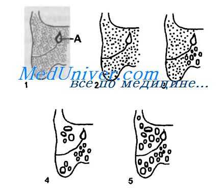 сосцевидный отросток