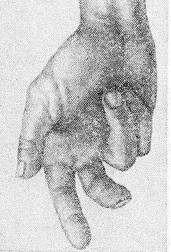 Рис. 1. Кисть руки больного с поражением срединного нерва: при попытке сжатия в кулак I, II и III пальцы не сгибаются, I палец не противопоставляется.