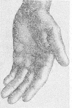 Рис. 2. Кисть руки больного с поражением срединного нерва ( «обезьянья рука» ): ладонь уплощена вследствие атрофии мышц возвышения большого пальца, I и II червеобразных мышц.