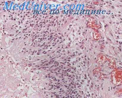 сосуды лучевой болезни