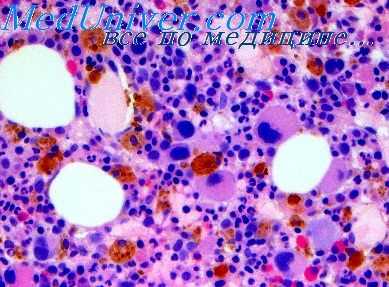 острая лучевая болезнь