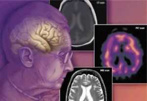 Сосудистая деменция