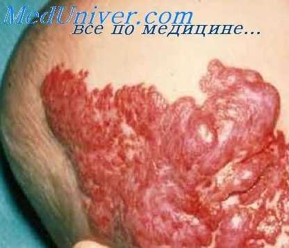 гемангиоперицитома