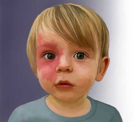 Капиллярная мальформация