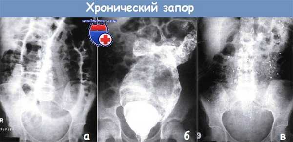 Хронический запор