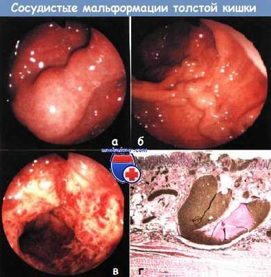 Сосудистые мальформации толстой кишки