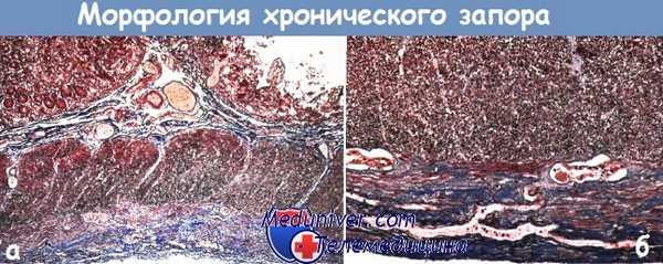 Хронический запор