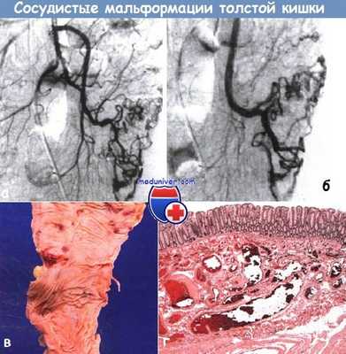 Сосудистые мальформации толстой кишки
