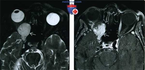 КТ, МРТ при кавернозной венозной мальформации глазницы (гемангиоме)